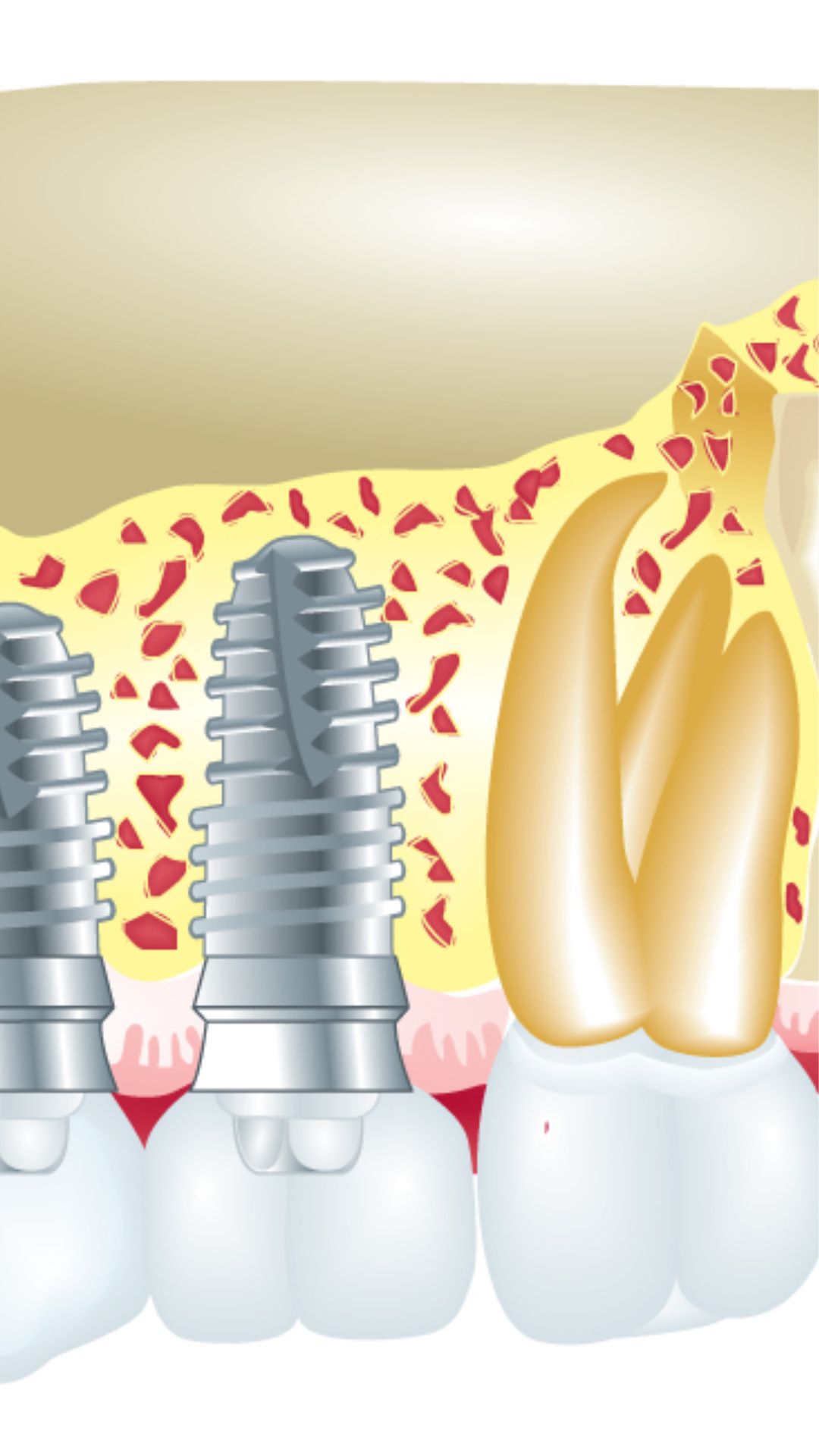 5. NEW IMPLANTS 5. NEW IMPLANTS