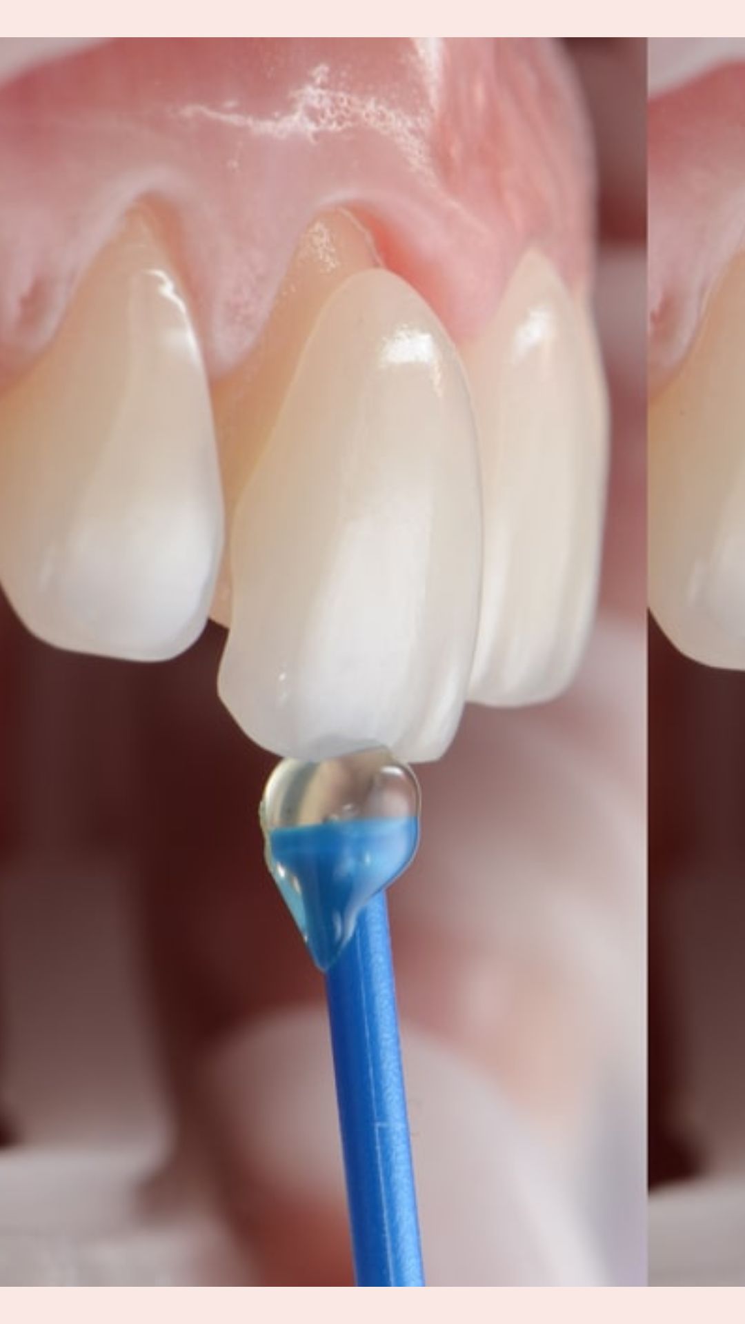 7.NEW VENEERS 7.NEW VENEERS
