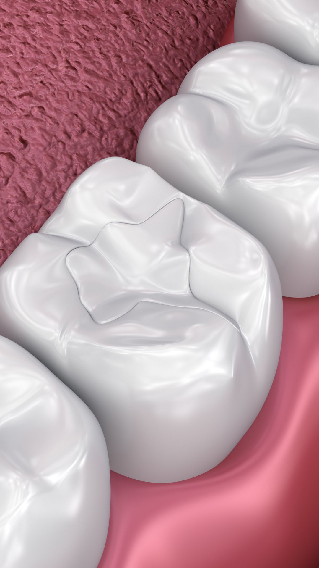 9. DENTAL FILLING 9. DENTAL FILLING