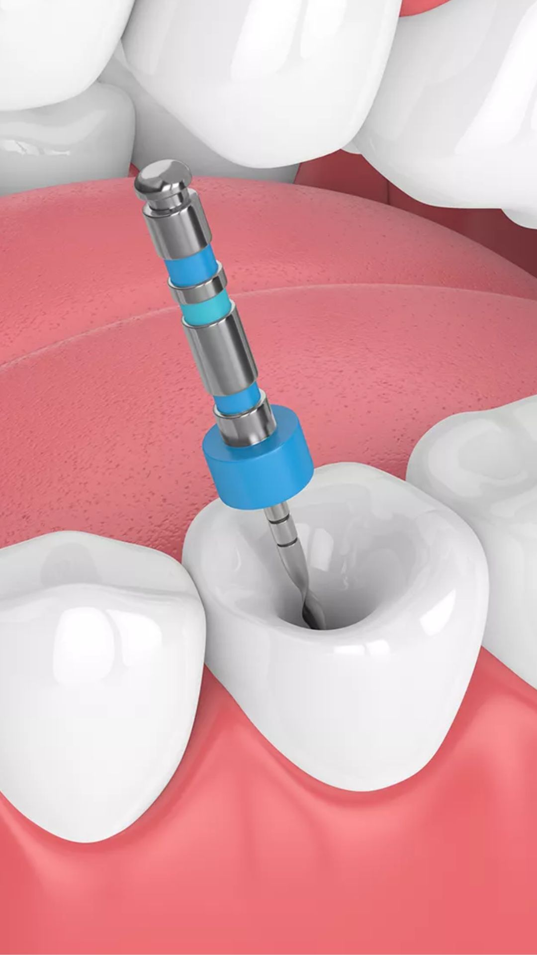 1. NEW ROOT CANAL 1. NEW ROOT CANAL